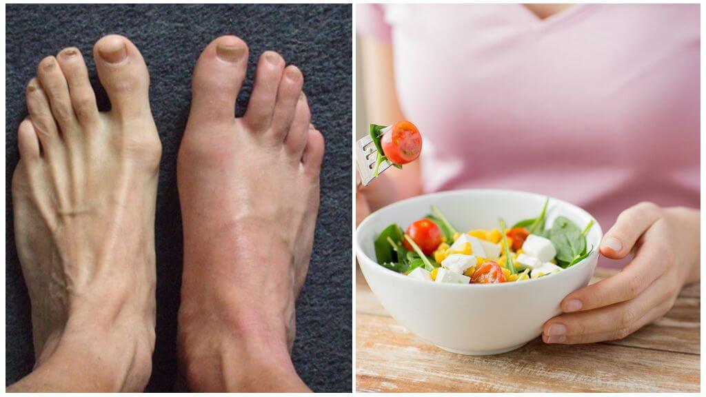 Подагра ног и соблюдение диеты